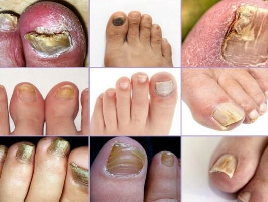 Danos nas uñas a varios tipos de fungos