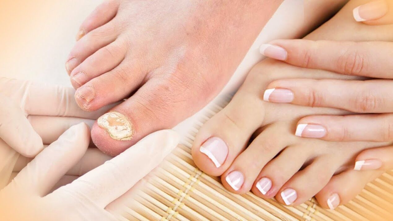 Fungo das uñas