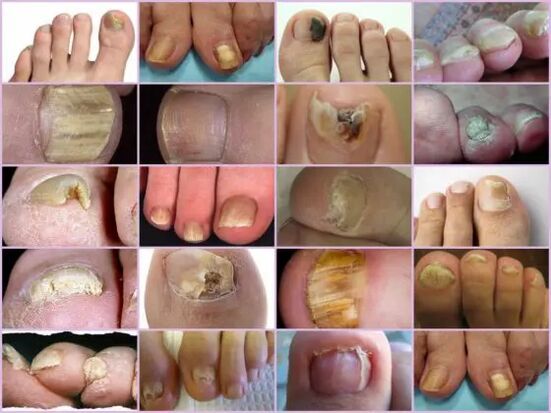 Onicomicosis de diversas localizacións na uña