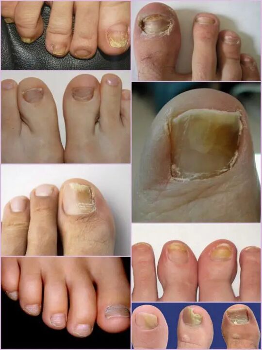 Variedades de fungo das uñas